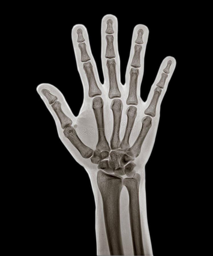 X Ray of hand. stock image. Image of hand, implant, radiation 92130249