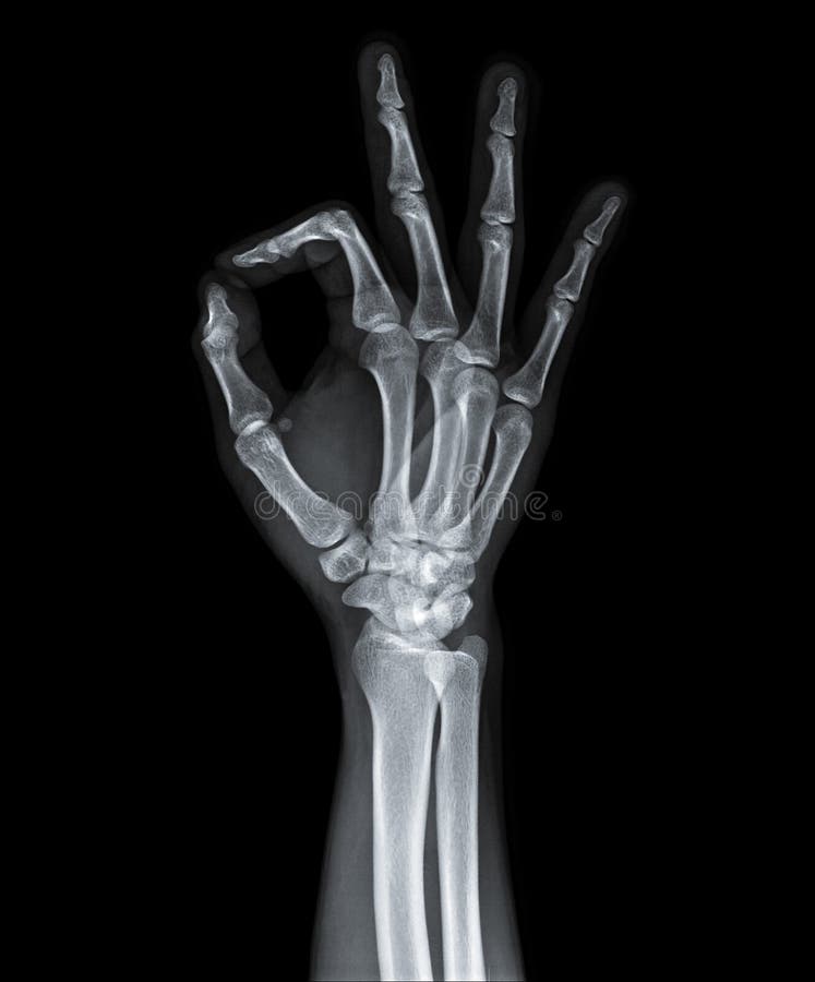 X Ray of hand. stock image. Image of fingers, diagnosis 92311079