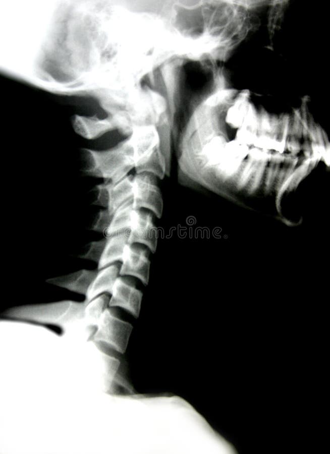Xray of head and neck stock photo. Image of radiology 2781464