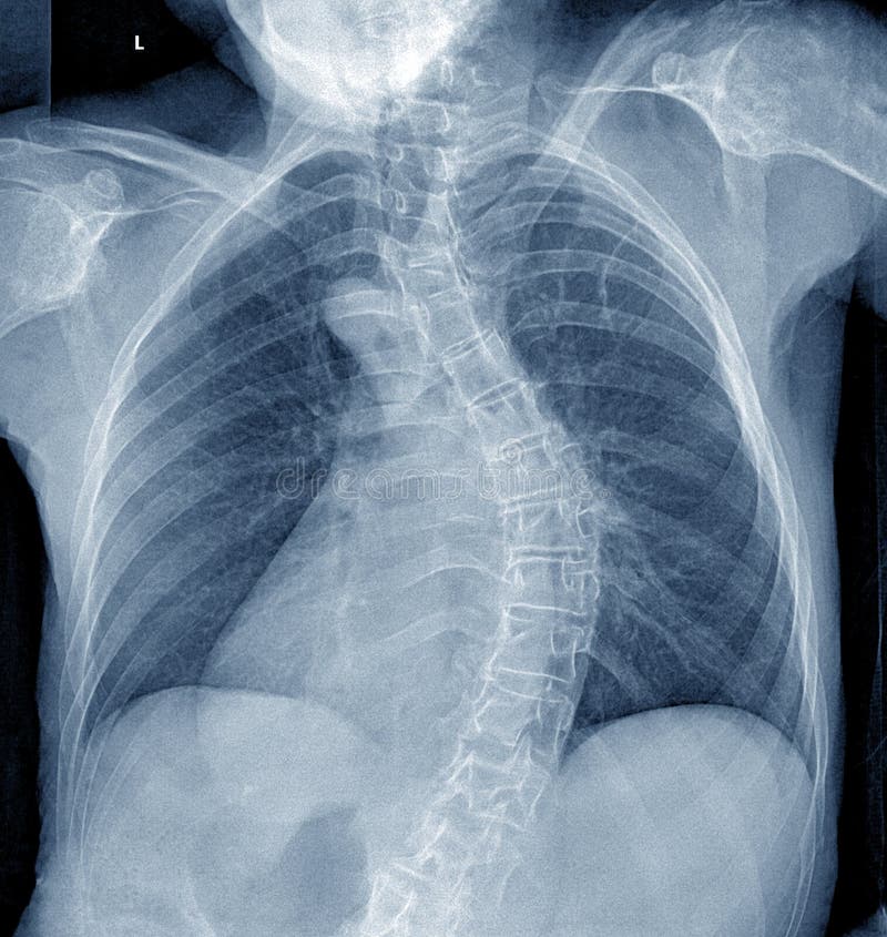 Xray of the Human Chest Organs, Cshaped Scoliotic Deformity of the