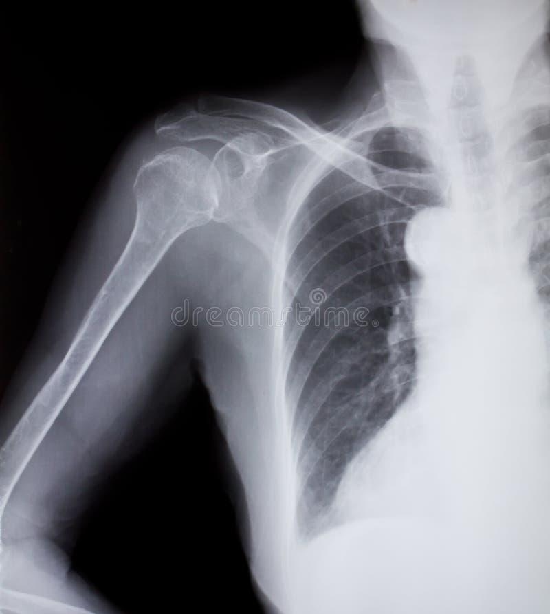 Fracture at Neck of Humerus ( Arm Bone ) ( Film Xray Left Shoulder and