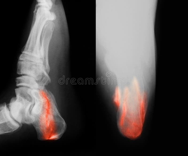 Broken Heel Xray Fixed with Screws and Plate, Foot Pain at Doctor