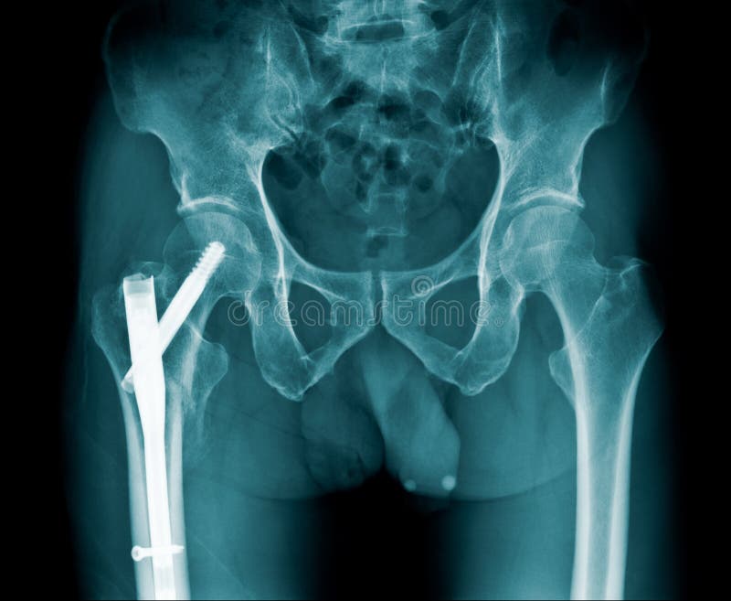 orif intertrochanteric fracture orif intertrochanteric fracture