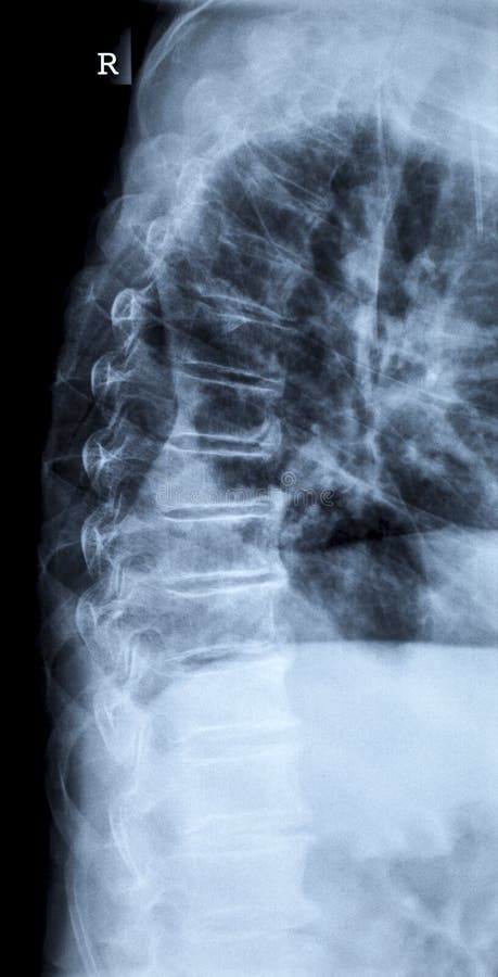 X-ray image of a human adult backbone, laterally view without any findings