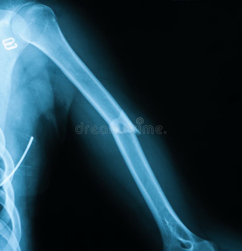 Xray Image of Humerus Fracture, AP View. Stock Photo Image of people, cervical 59188558