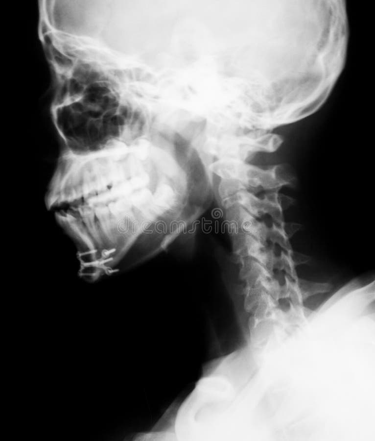 Xray Image Of Mandible, Lateral View. Stock Photo Image 53839709