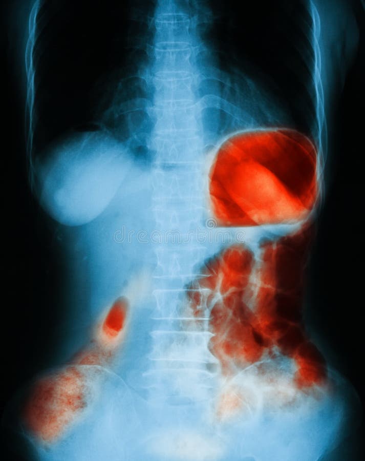 Xray Image of Plain Abdomen Upright. Stock Photo Image of anatomy, jejunum 55031142