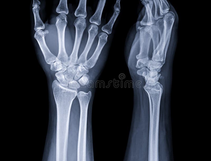 Xray Image of Wrist Joint for Diagnosis Rheumatoid Arthritis Stock