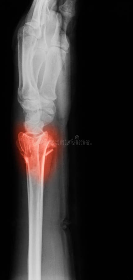 102+ Thousand Colles Fracture Royalty-Free Images, Stock Photos & Pictures