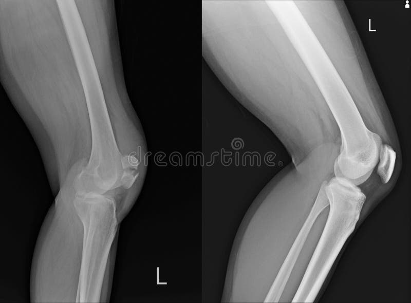 X-ray Left Knee lateral Showing Kneecap normal and fracture.