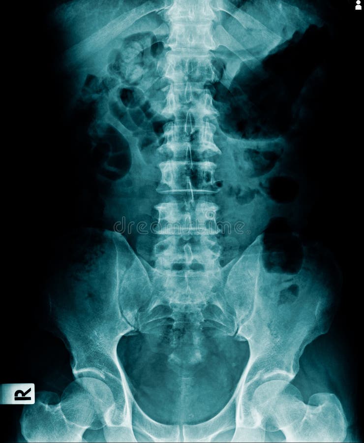 Xray lumbar stock photo. Image of hospital, person, back 95002220