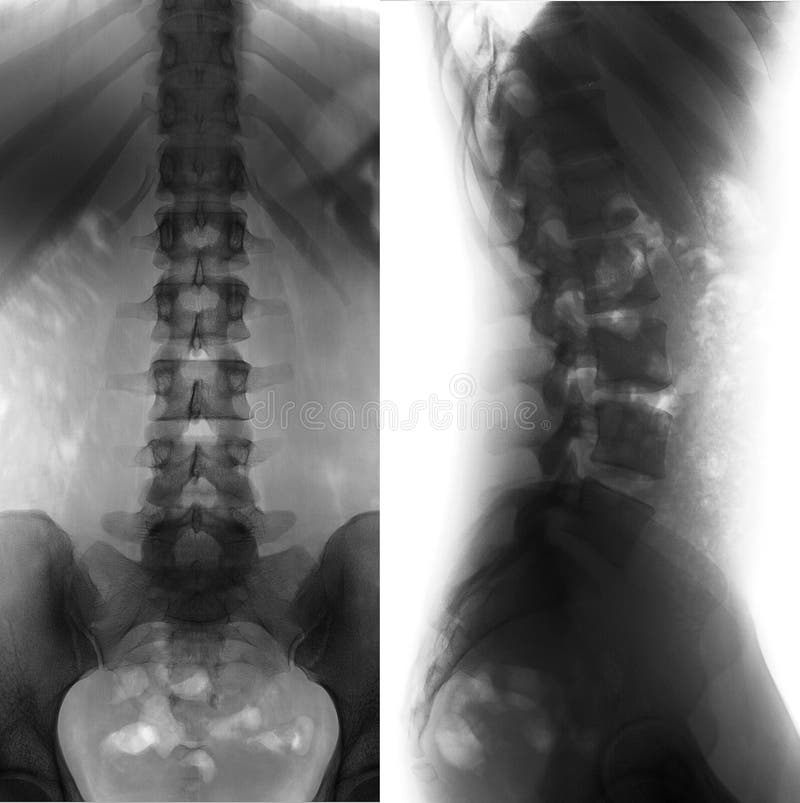 X-ray of the Lumbar Spine. Wedge-shaped Deformed Body of the Vertebra. Stock Image - Image of