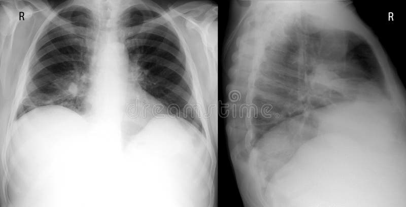 X-ray lung the front and right lateral proection. showing a large infiltrate in the middle lobe of the right lung. Pneumonia.