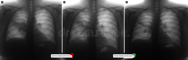 Air that cuts off circulation to a segment of the lung dead space Air that cuts off circulation to a segment of the lung dead space