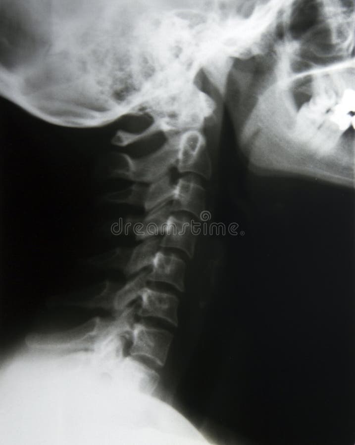 Fracture At Neck Of Humerus ( Arm Bone ) ( Film Xray Left Shoulder And