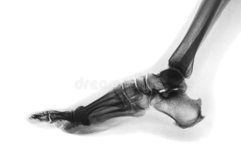 X-ray normal human foot . Lateral view . Invert color style