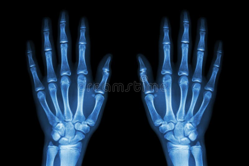 Xray Normal Human Hands (front) On Black Background Stock Image