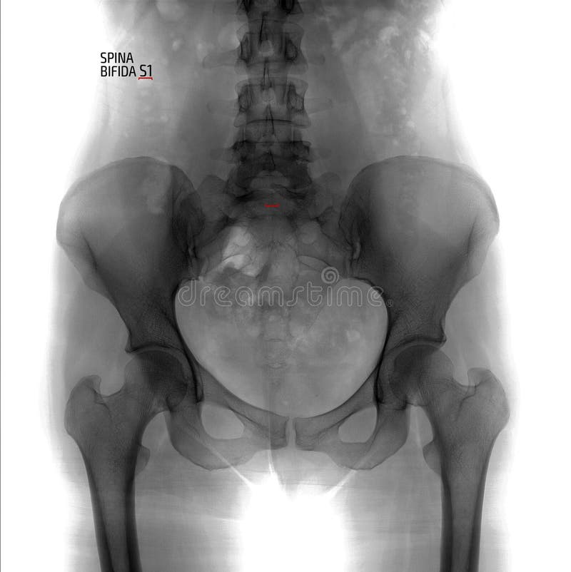 De sartén a lumbosacro columna vertebral.