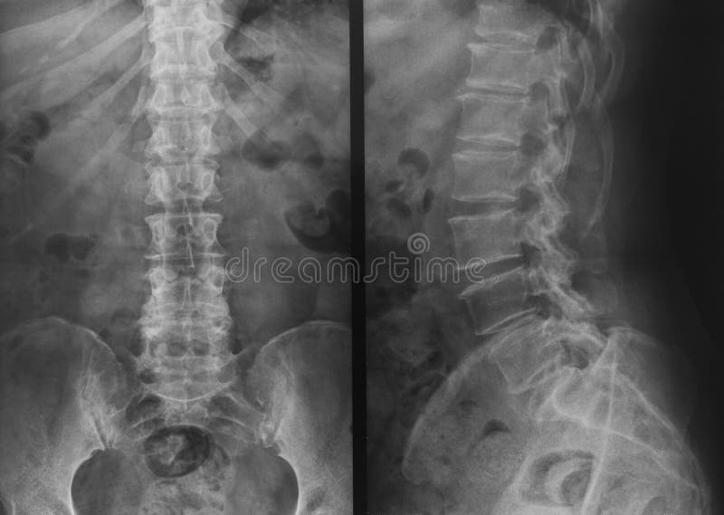 X-ray of pelvis and spinal column royalty free stock photos X-ray of pelvis and spinal column royalty free stock photos