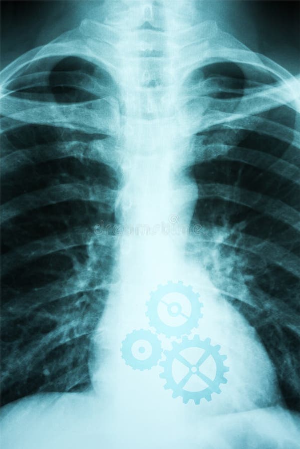 XRay Photo of Human Heart stock image. Image of disease 49477919