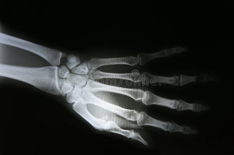 X-ray photos of bone fracture patients royalty free stock photography X-ray photos of bone fracture patients royalty free stock photography