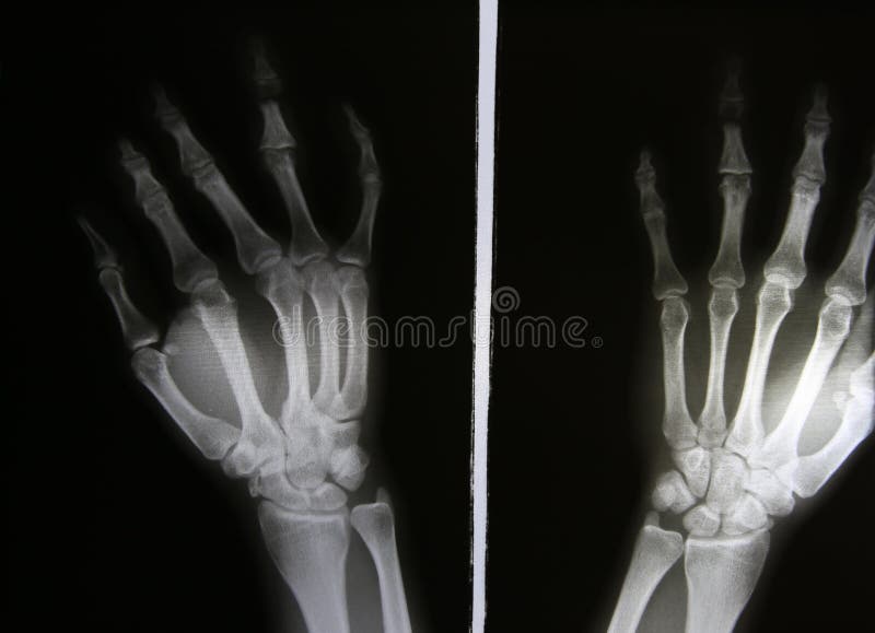 X-ray photos of bone fracture patients royalty free stock images X-ray photos of bone fracture patients royalty free stock images