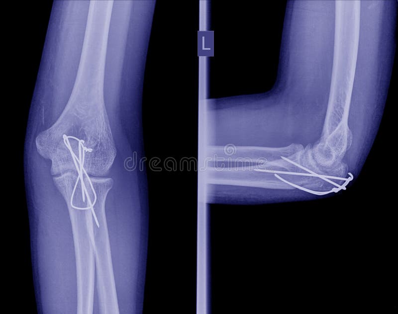 Xray Elbow Post Operation Internal Fixation Elbow Fracture Stock Image