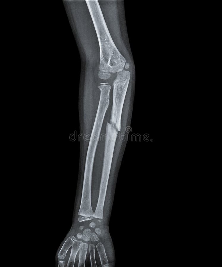 X Ray ręka z przełamem obrazy royalty free