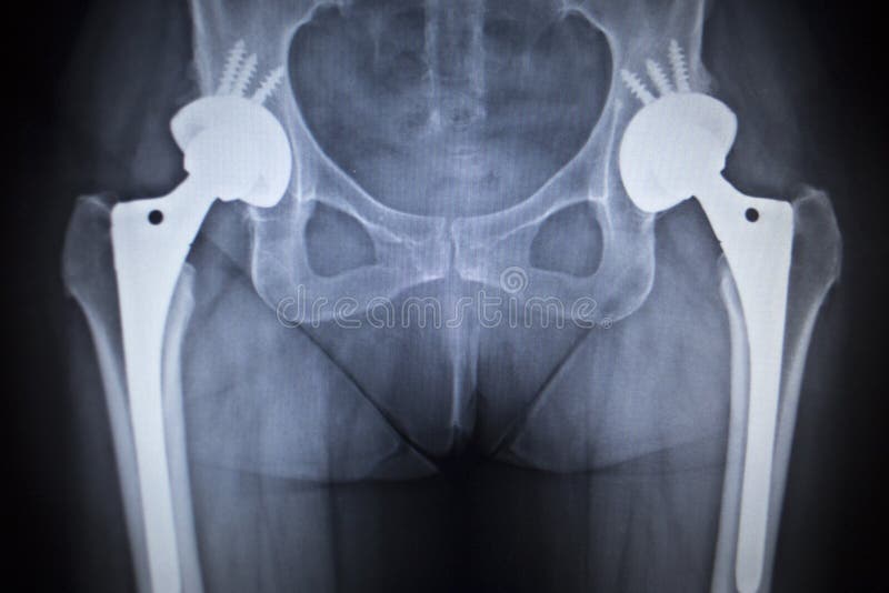 X-ray skenovanie obrázka z bedrových kĺbov s ortopedické bedrového kĺbu implantát hlavu a skrutky v ľudskej kostry v modrej, šedej tóny.