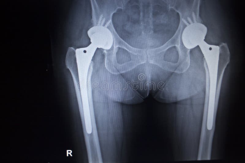 X-ray skenování obraz kyčelních kloubů s ortopedickou kyčelního kloubu implantát hlavu a šrouby v lidské kostry v modré, šedé tóny.