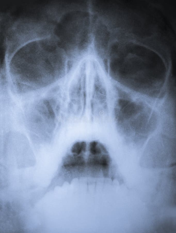 X-ray scan of sinuses of nose