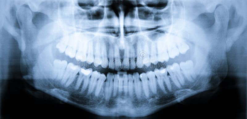 X-ray scan of teeth