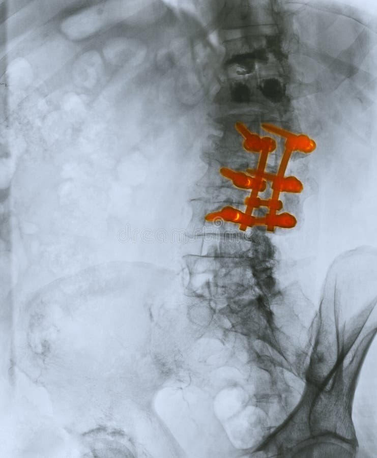 Lumbar spine x-ray of an 80 year old man who underwent a spinal fusion operation. This patient also had a kyphoplasty for compression fractures of the two vertebrae above the area of spinal fusion. Kyphoplasty is a medical procedure that attempts to stop the pain caused by the bone fracture and attempts to restore the height and angle of kyphosis of a fractured vertebra (of certain types), foll. Lumbar spine x-ray of an 80 year old man who underwent a spinal fusion operation. This patient also had a kyphoplasty for compression fractures of the two vertebrae above the area of spinal fusion. Kyphoplasty is a medical procedure that attempts to stop the pain caused by the bone fracture and attempts to restore the height and angle of kyphosis of a fractured vertebra (of certain types), foll