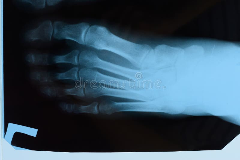 Xray Of Toes. Foot On Xray. Bone Research Stock Image Image of