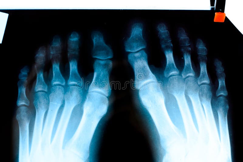 Xray of Toes. Foot on Xray. Bone Research Stock Image Image of