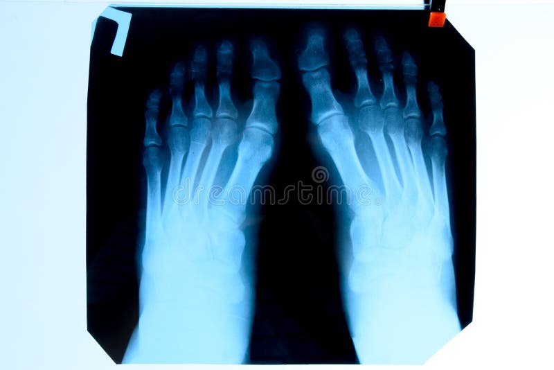 Xray of Toes. Foot on Xray. Bone Research Stock Image Image of