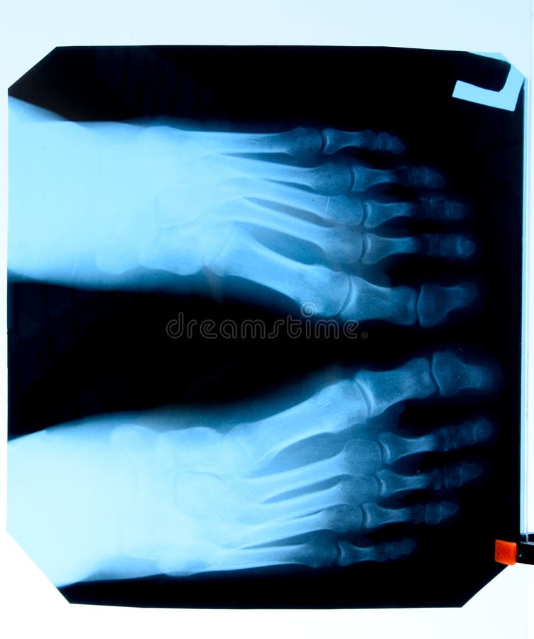 Toes on the Foot of a Newborn Baby, Closeup. Macro Photo of a Healthy Toe of a Child Stock