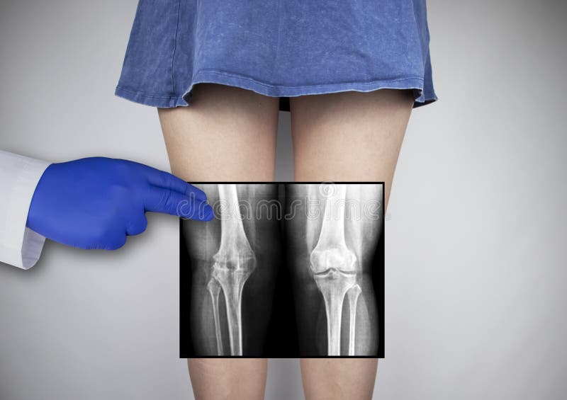 X-ray of a woman`s knees. 