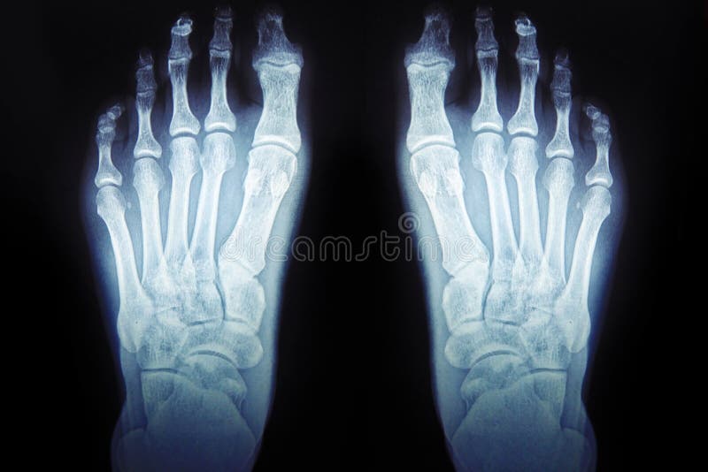 Xray of the Foot. Human Bones. Real Xray Leg, Side View Stock Image