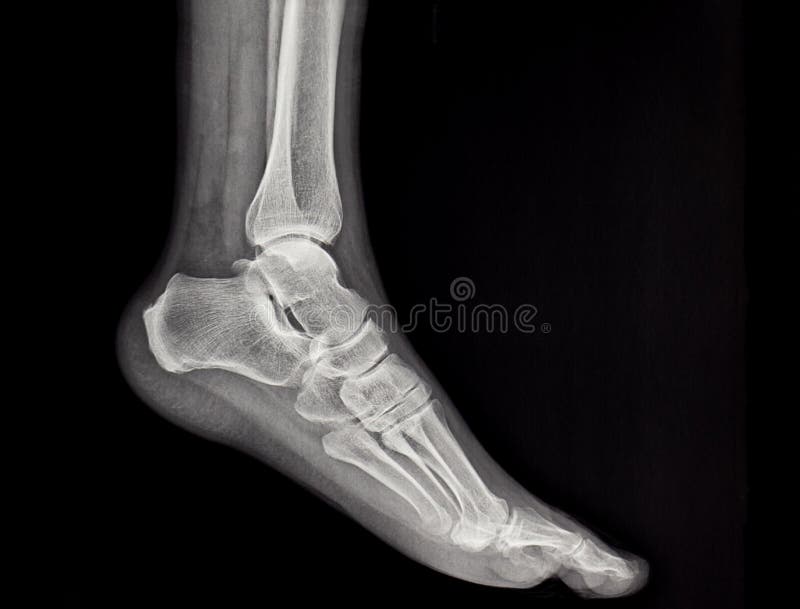 Xrays of the human foot stock photo. Image of hospital 254932506