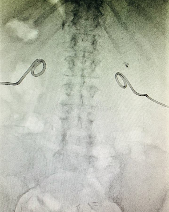 Xray Bilateral Nephrostomy Position Control Stock Image Image of