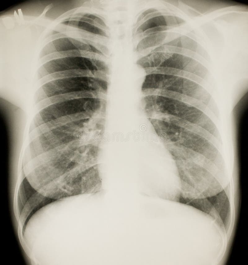 Xray of chest, normal