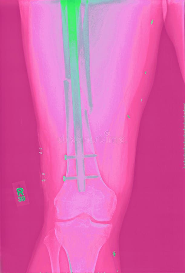 A real xray, colorized, of a repaired femur fracture after a motorcycle accident. The repair is held in place with a rod and IM (intramedullary) nails. A real xray, colorized, of a repaired femur fracture after a motorcycle accident. The repair is held in place with a rod and IM (intramedullary) nails.