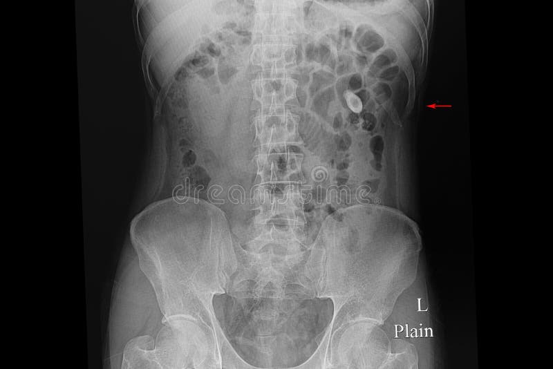 Xray film of a patient with multiple kidney stones. Xray film of a patient with multiple kidney stones