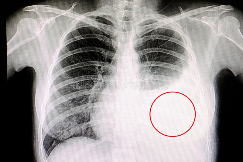 Pleural Effusion stock photography Pleural Effusion stock photography