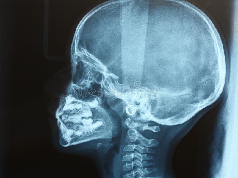 Xray of the Head of a Child or Kid Side View Stock Image Image of