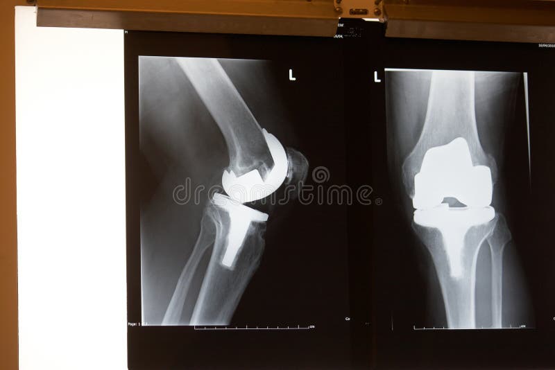 Xray, 46 Year Old Female, Total Knee Replacement Stock Image Image of surgery, orthopedic