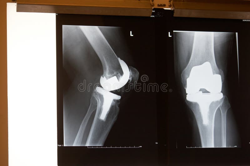 Xray knee replacement.