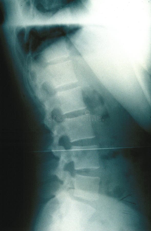 xray kręgosłup człowieka xray kręgosłup człowieka