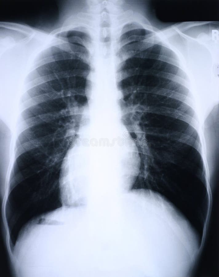 Xray del polmone vista frontale.